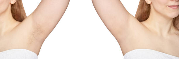 Before & After Photos – Underarm or facial hair
