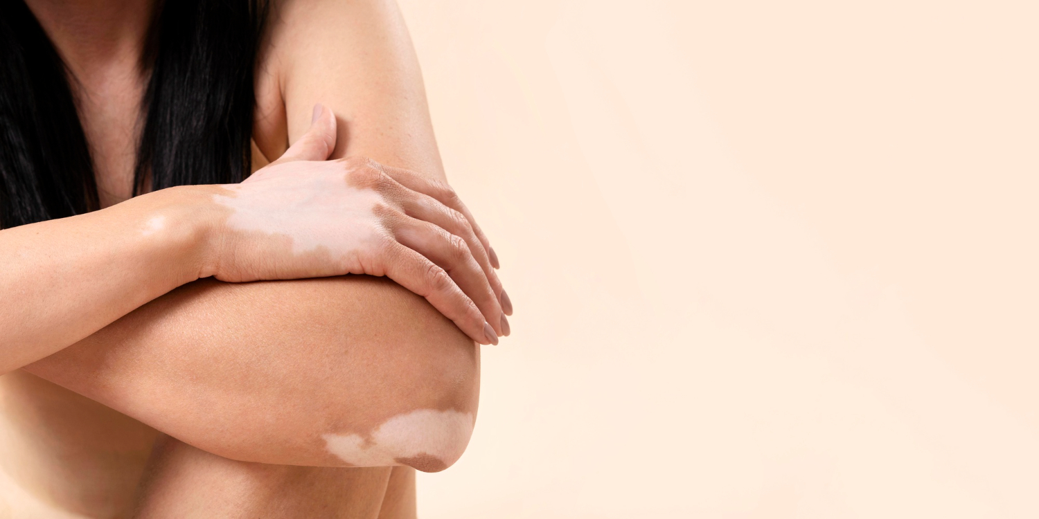 Vitiligo / Psoriasis Laser