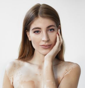Vitiligo / Psoriasis Laser