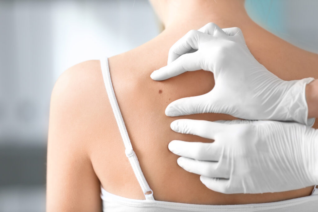 Skin Biopsy