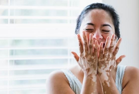 Vitiligo / Psoriasis Laser